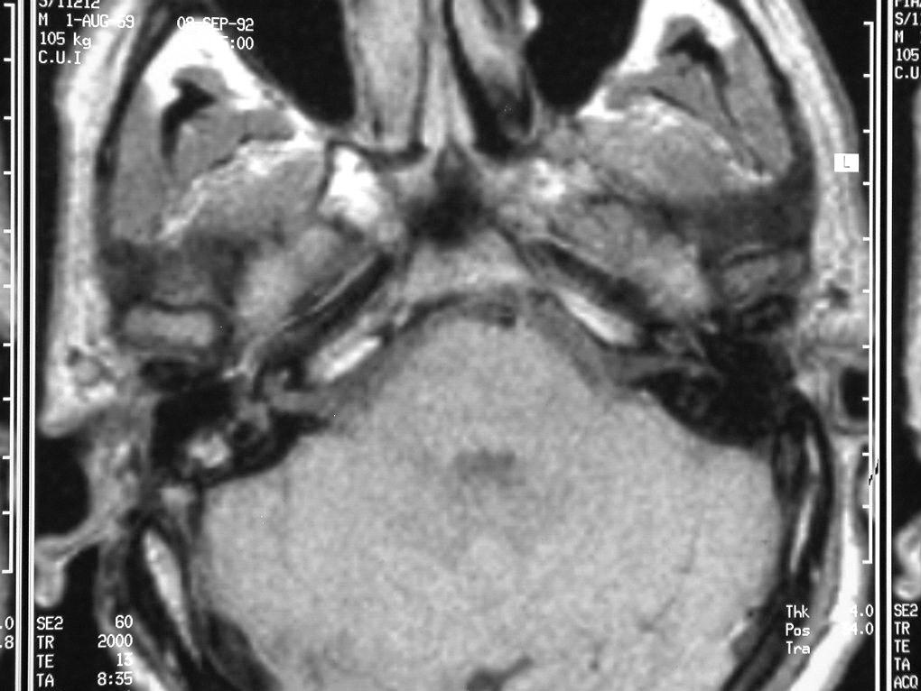Intrapetrous facial nerve tumors: Report of 3 cases and literature review CASE REPORTS Case 1 A 33-year-old man underwent a right radical mastoidectomy for cholesteatoma in October 1989.