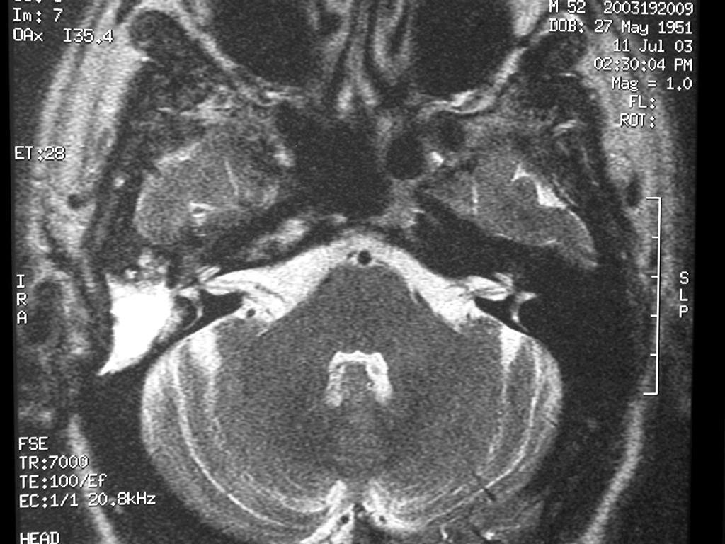 After 3-years follow up, the patient shows no signs of recurrence or facial nerve palsy.