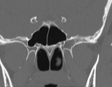 Orbital Fissures/Foramen Anterior Clinoid Foramen