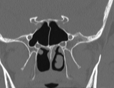 Orbital Fissures/Foramen Anterior Clinoid Foramen Rotundum