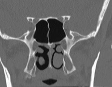 Orbital Fissures/Foramen Optic Canal Anterior Clinoid