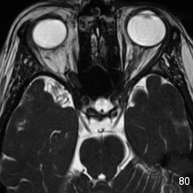 Cranial Nerve III: Oculomotor Nerve Cavernous Sinus CN III Origin: Midbrain Course: Cistern (passes between posterior cerebral