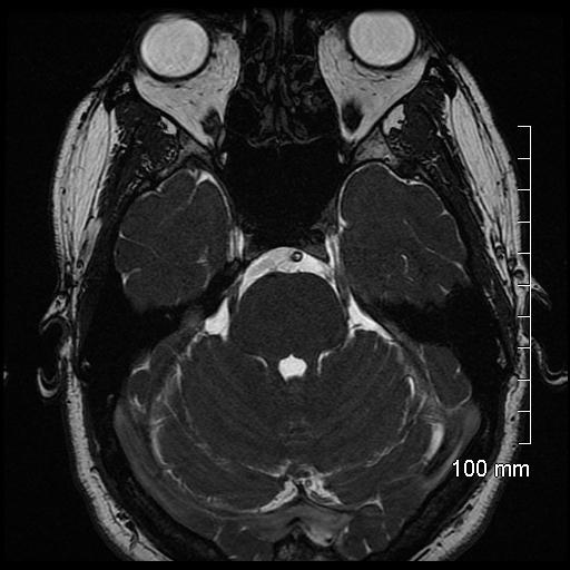 Cranial Nerve V: Trigeminal Nerve CN V Origin: Pons Course: Cistern Trigeminal ganglion Divides into (3) branches: V1 Ophthalmic, V2