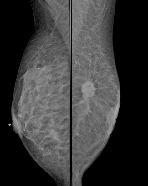 Mammogram - mass