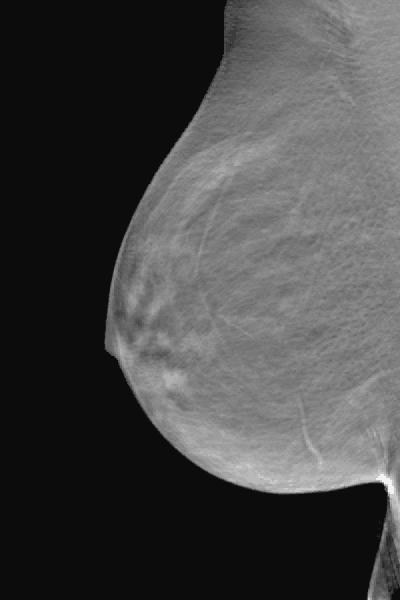 Breast Tomosynthesis Breast