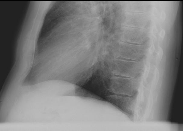 FISSURE Diaphragm- Lateral view