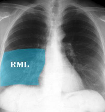 Lung Anatomy on Chest X-ray The right middle lobe is typically the smallest