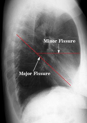 Lung Anatomy on Chest X-ray These lobes can be separated from one another by two fissures.