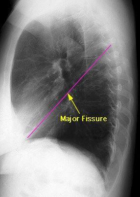 Lung Anatomy on Chest X-ray These two lobes are separated by a major fissure, identical to that seen on the right side, although often slightly
