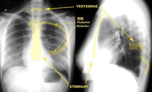 Systematic Approach Bony Fragments Ribs
