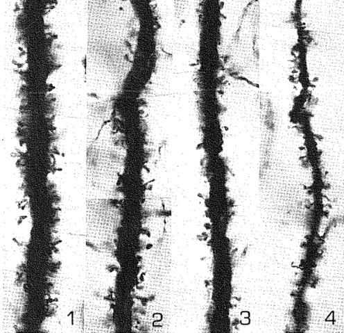 Loss of dendritic spines in AD