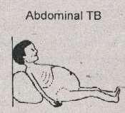 ABDOMINAL TUBERCULOSIS Swallowed Sputum Hematogenous Forms