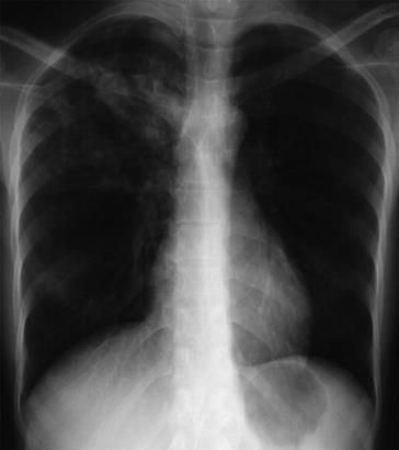 Radiologic Studies CXR : suspicious but does not confirm TB Multinodular infiltration superior segments of lower lobes apical segment of upper lobes Cavitation Hilar adenopathy Old (healed) TB