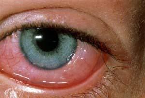 hemorrhage Symptoms: redness, FBS, *white-yellow discharge, mild itching Treatment: topical antibiotic eye drop *Look for starred items for best