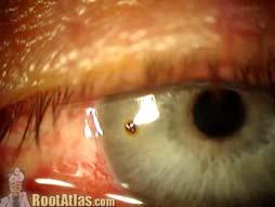 right away (could be corneal condition) Symptoms: