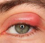Symptoms: bump on eyelid, eyelid swelling, tenderness, *no visible opening/sore Treatment: