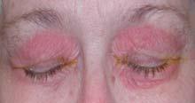 sudden onset of rash/redness around eyes, eyelid swelling, mild