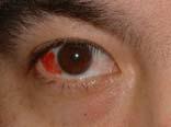 symptoms except very red eye, eye looks bloody Treatment: