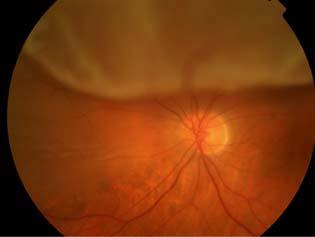 part of vision, vision loss (anywhere) Treatment: referral to surgeon for repair surgical options: laser