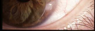 suspected retained intraocular foreign