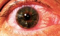 products Signs and Symptoms: Decreased visual acuity, conjunctiva injection, possible change