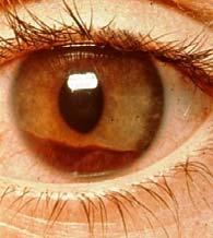 paralysis of the iris and mydriasis rests the iris, reduces pain, prevents synechiae