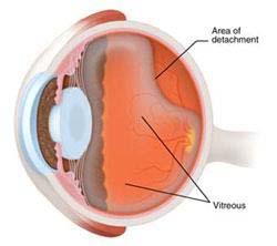 RETINAL DETACHMENT Retina is a thin layer of light sensitive nerve cells at the back of the eye that help us see clearly Detachment