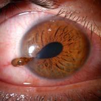 RETINAL DETACHMENT Photopsia Peripheral flashes of light, usually occurring with eye movement A heavy feeling in the eye