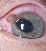 RUPTURED GLOBE History of trauma Assess for acute cranial injury first Associated extraocular injury Acute loss of vision or