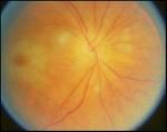 Immediate Classification A. Sudden Loss of Vision B. Flashes of Light C. Sudden Spots in Front of Eyes D.