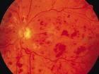 Sudden Loss of Vision (Painless) Central Retinal Artery Occlusion Central Retinal Vein Occlusion Vitreous Hemorrhage