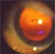 Sudden Loss of Vision (Painful) Acute Angle Closure Glaucoma Ischemic Optic Neuropathy Optic Neuritis Retinal