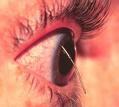 rupture Must rule out retinal detachment or choroidal rupture Must also rule