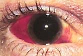 A. Red Eye Identify exposure or likely FB incident PAIN is first