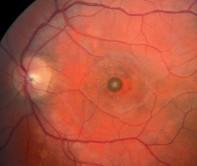 hemorrhage (arrow) and retinal edema, suggesting a break in Bruch s membrane caused