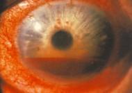 vision Signs: Blood in anterior chamber (AC) Treatment: VA,