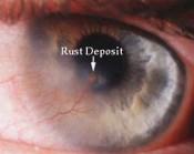 of small FBs) If fails: Contact receptor Diabetic Retinopathy Breakage in the blood vessels in the fundus Macula bleeding is more significant Ensure your patient has a take home Amsler Grid Corneal