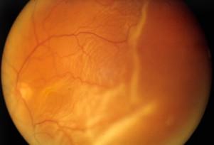 Retinal Detachment Testing Not just the globe!