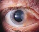 Pinquecula Elevated bump or nodule (fatty plaque), usually in nasal bulbar conjunctiva Symptoms: occasional irritation/redness, allergies can cause flare-up Treatment: Lubricants (artificial tears)