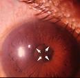 Foreign body from grinding machine d. Gradual decreased in vision for 90 days Iris Bombe involves what main structures? a. Iris, corneal, crystalline lens b. Retina, crystalline lens c.
