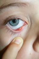 Contact Lens Pain Cellulitis Identify exposure or likely FB incident PAIN is first indication Followed by: Decreased VA Discharge Excessive tearing