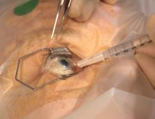 Subconjunctival anesthesia was used in the phase 3 clinical trials of OZURDEX (dexamethasone intravitreal implant). 3 (continued on next page) 1 2 3 4.
