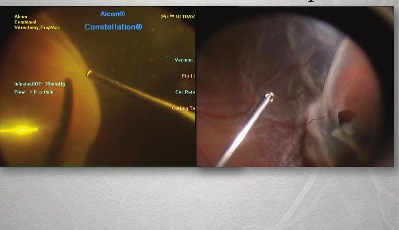 Advantages of the Ultravit High Speed Cutter BY KAZUAKI KADONOSONO, MD As vitrectomy surgery becomes more commonplace, retinal surgeons need the most effective technology at their disposal.