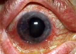 Signs of uveitis Red eye Circumlimbal