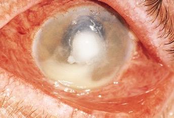 of posterior uveitis including infections e.