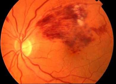 Thrombotic event; usually seen with diabetes, glaucoma, hyperlipidemia Sudden onset of painless unilateral vision loss