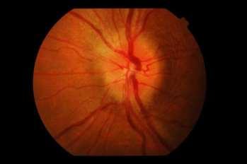 Unilateral vision loss Color vision alteration Flashing lights Papillitis MRI with