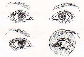 Misalignment of the eyes resulting