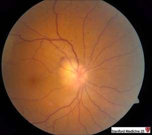 Swelling of the optic disc/nerve secondary to