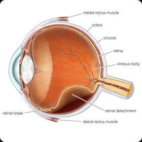 The retina detaches from the underlying epithelial